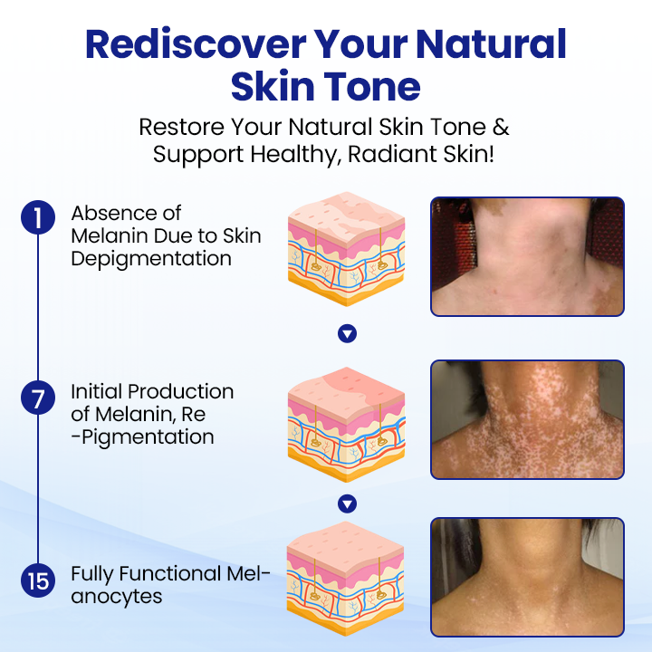 🌿KUBOZN® Vitiligo Repigmentation Spray — Visible Results in 7 Days, Steroid-Free