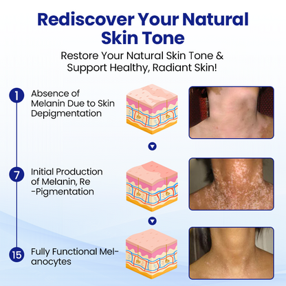 🌿KUBOZN® Vitiligo Repigmentation Spray — Visible Results in 7 Days, Steroid-Free