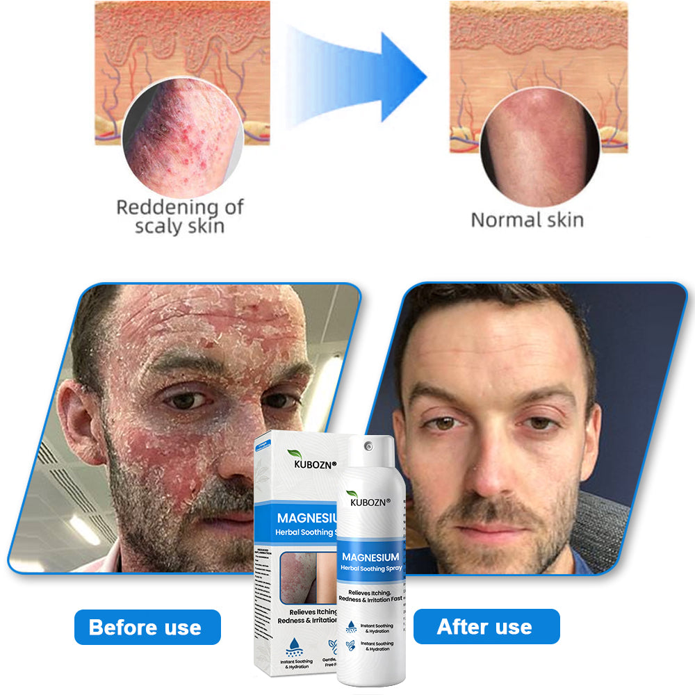 H✅ Official Store: KUBOZN® Magnesium Herbal Psoriasis Spray 👨‍⚕️ Clinically Tested & Compliant with Health Canada Skincare Standards (Relieves psoriasis and eczema, helps improve bacterial infections in the genital area, treats acne and warts)