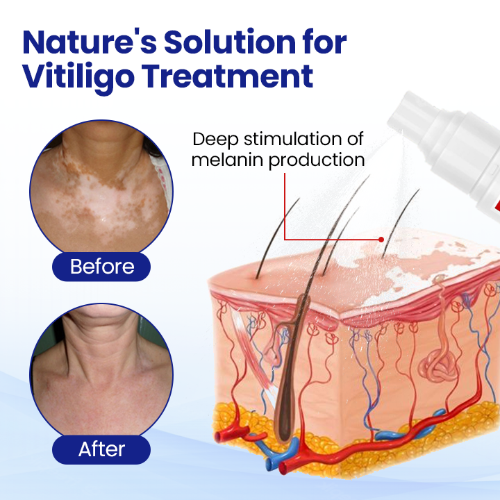 🌿KUBOZN® Vitiligo Repigmentation Spray — Visible Results in 7 Days, Steroid-Free