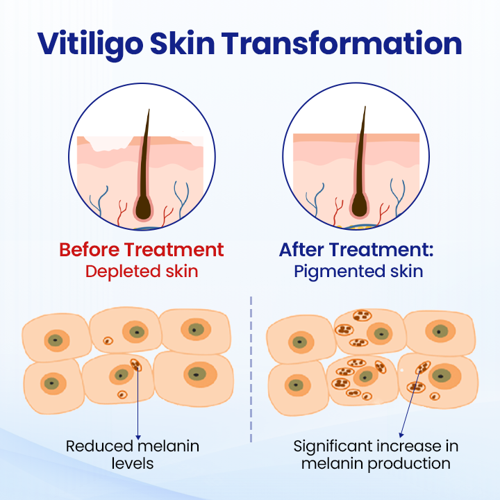 🌿KUBOZN® Vitiligo Repigmentation Spray — Visible Results in 7 Days, Steroid-Free