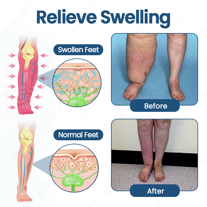 KUBOZN® Roll-On  Cream for Lymphatic Drainage & Swelling Relief (offer)