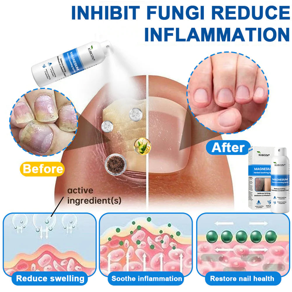 H✅ Official Store: KUBOZN® Magnesium Herbal Psoriasis Spray 👨‍⚕️ Clinically Tested & Compliant with Health Canada Skincare Standards (Relieves psoriasis and eczema, helps improve bacterial infections in the genital area, treats acne and warts)