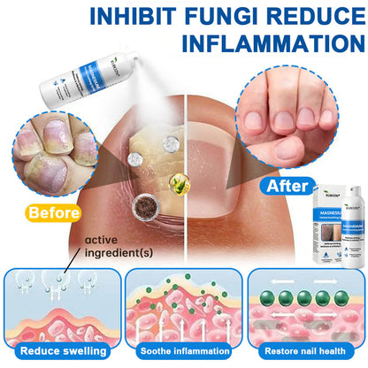 H✅ Official Store: KUBOZN® Magnesium Herbal Psoriasis Spray 👨‍⚕️ Clinically Tested & Compliant with Health Canada Skincare Standards (Relieves psoriasis and eczema, helps improve bacterial infections in the genital area, treats acne and warts)